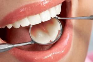 Profilaxis dental en Javea : caries ... Dentist Javea
