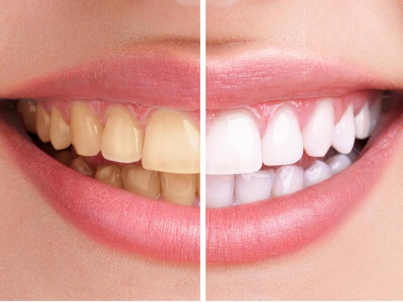 Blanqueamiento dental en Javea