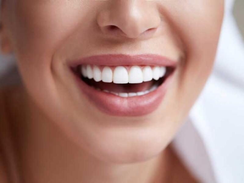 Carillas dentales en Javea