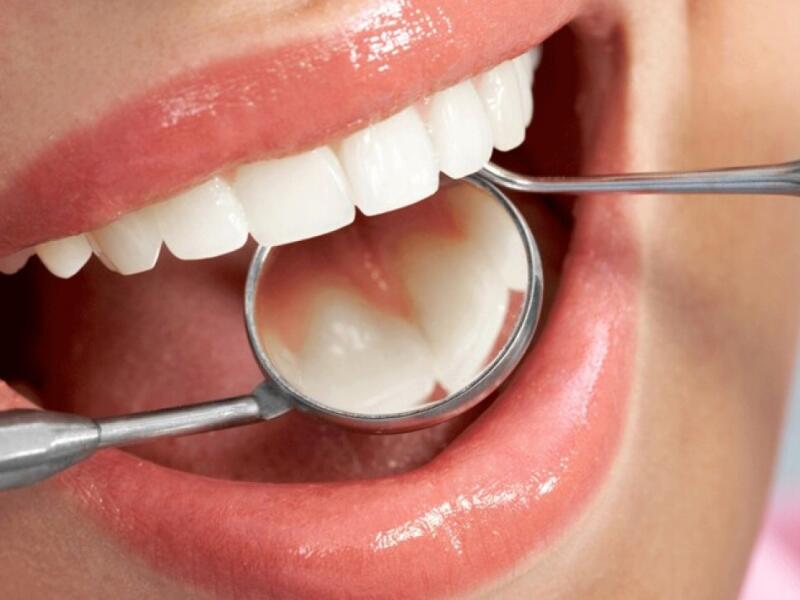 Profilaxis dental en Javea : caries ... Dentist Javea